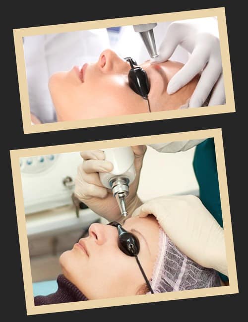 Видалення татуажу неодимовим лазером Q-switch