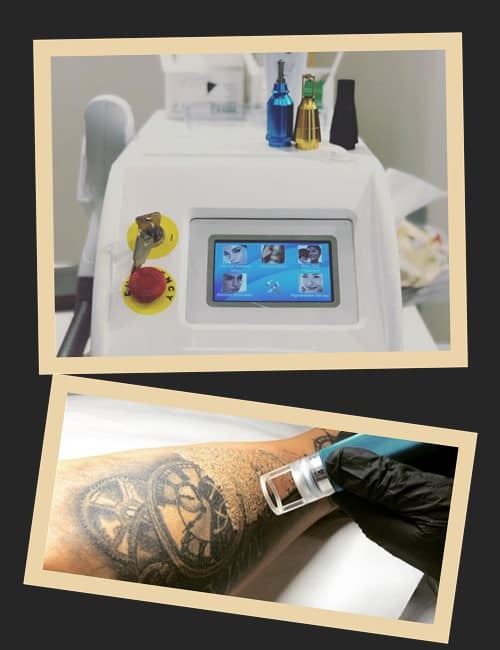 Чинники, що впливають на швидкість виведення татуювання