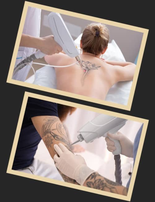 Скільки коштує тату звести лазером
