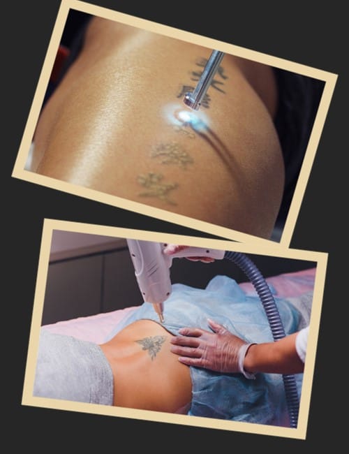 за скільки сеансів видалити тату