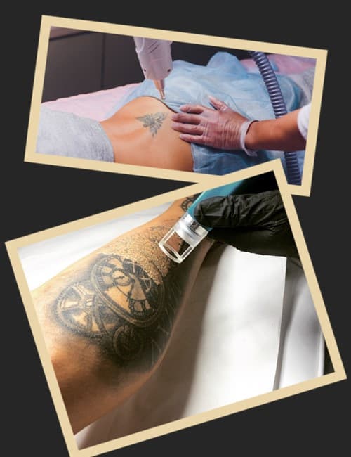 Від чого залежить ефективність методу видалення тату