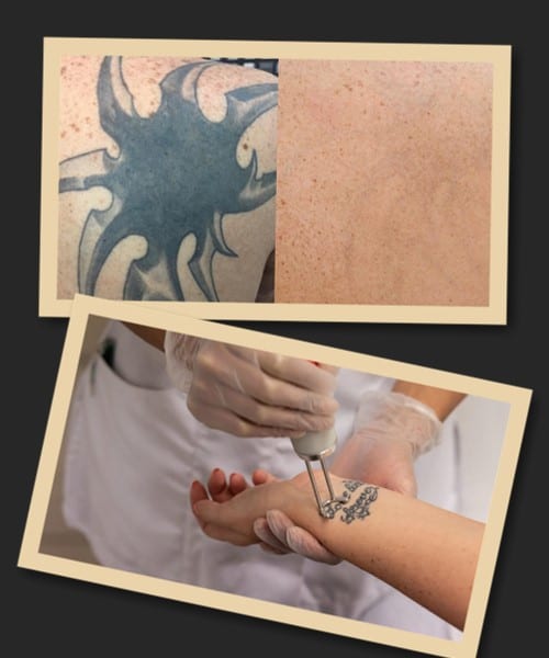 Видаляти татуювання лазерним методом