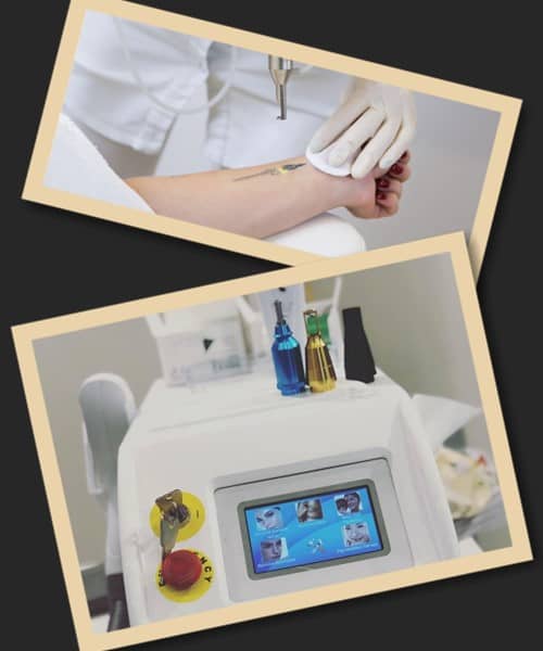 лазерне видалення тату