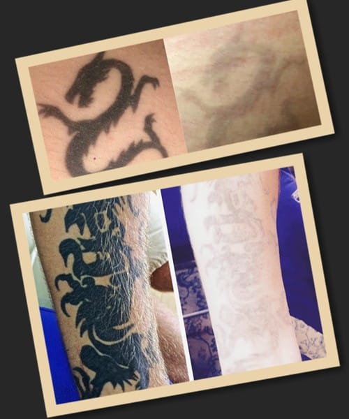 Кріодеструкція видалення тату