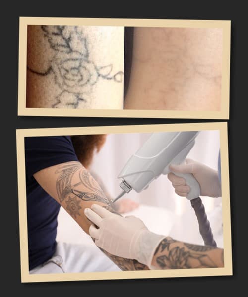 Ефективність лазерного видалення татуювання