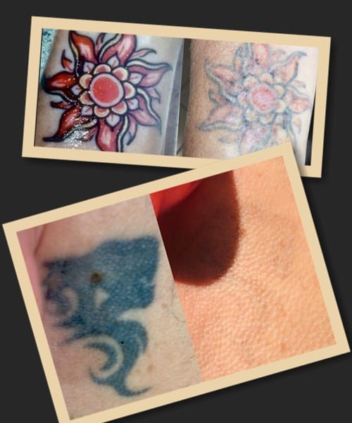 Що безпечніше – ремувер чи лазер?