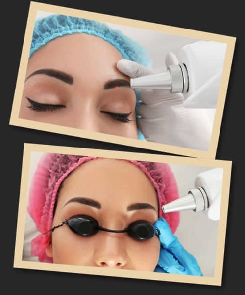 Лазерний метод виведення перманентного макіяжу