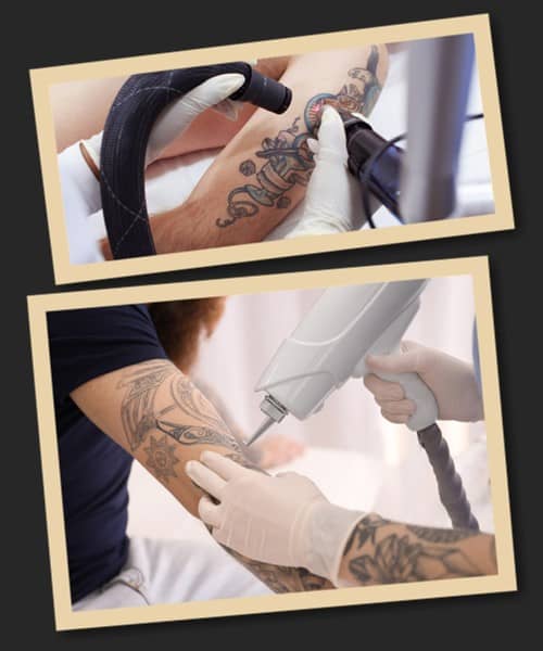 Переваги лазерної обробки тату