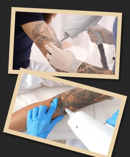 Виведення тату лазером