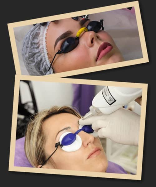 Лазерний метод виведення перманентного макіяжу