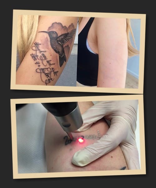 Виведення татуювань лазером