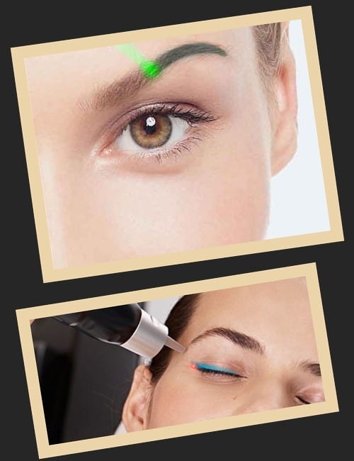 Від чого залежить кількість сеансів видалення татуажу