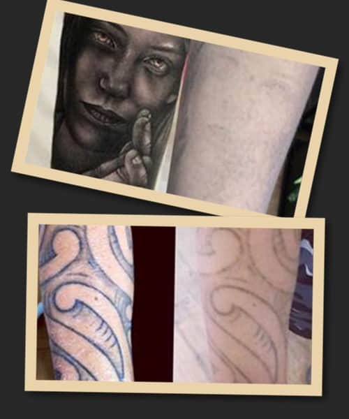 Зведення тату хімічним способом