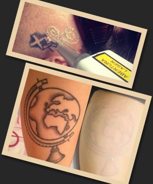 мінімальна вартість виведення тату