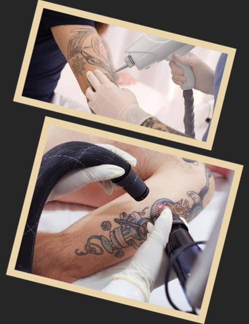 Найбезпечнішим методом у Києві є неодимовий лазер