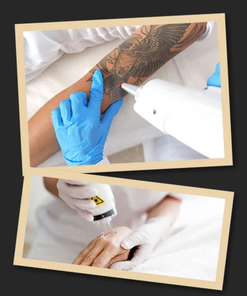 Як виводять татуювання