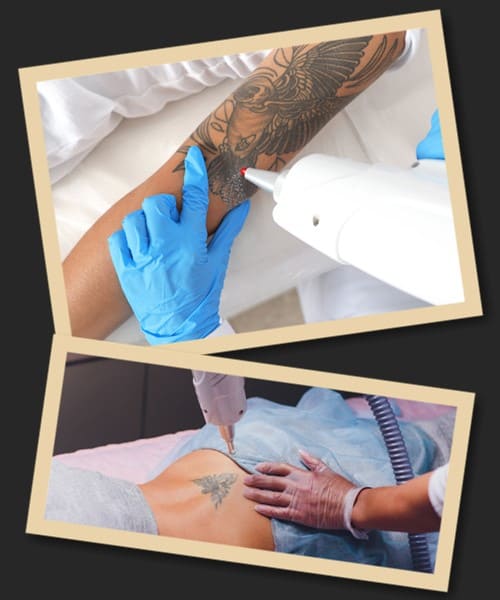 Пікосекундний лазер для видалення татуювання