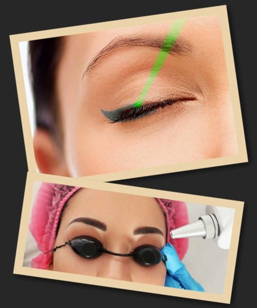 Видалити татуаж у Києві