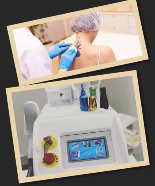 Метод лазерного зведення тату