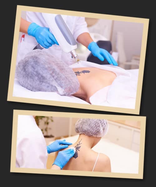 Руйнування пігменту лазером