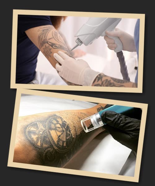 Лазерний спосіб зведення татуювань