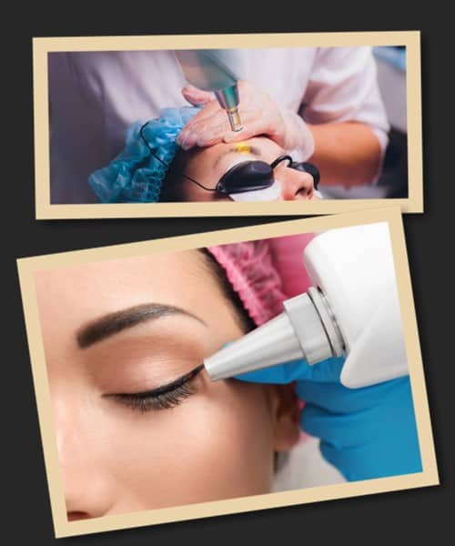 Особливості лазерної методики видалення татуажу