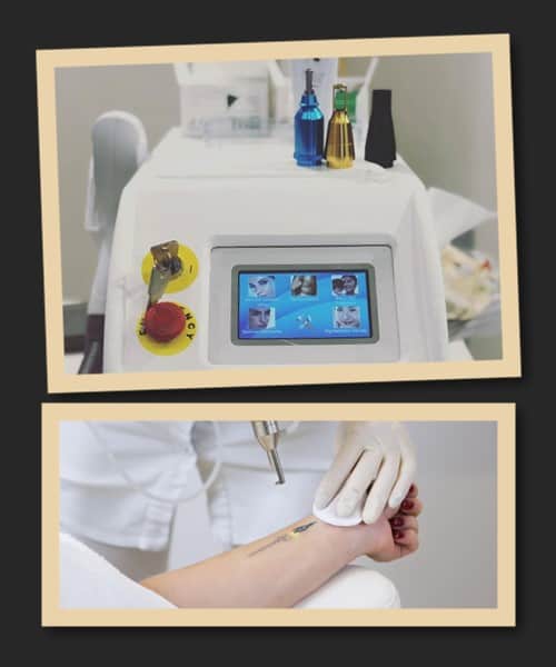 Переваги лазерного способу видалення тату