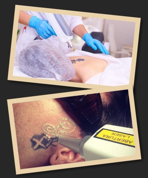 Пікосекундний лазер – що таке?