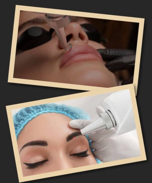 Лазерне виведення татуажу