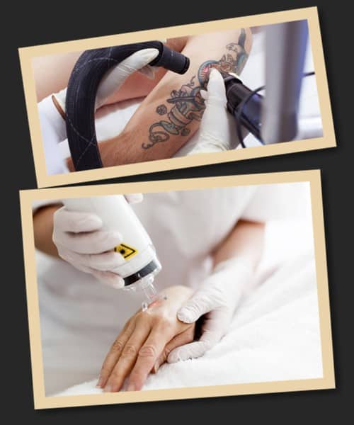 Виводити старі або непотрібні малюнки з тіла пікосекундним лазером