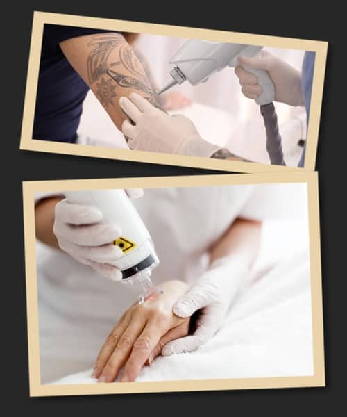 Фактори, що впливають швидкість видалення тату