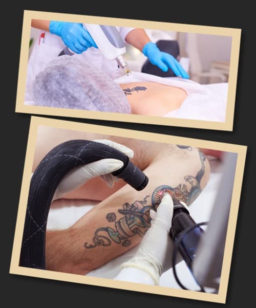 Особливості лазерного методу видалення тату