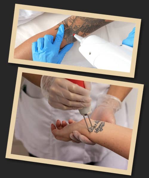 швидкість видалення татуювання