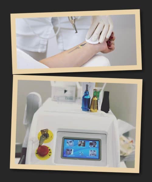 лазерний метод видалення тату