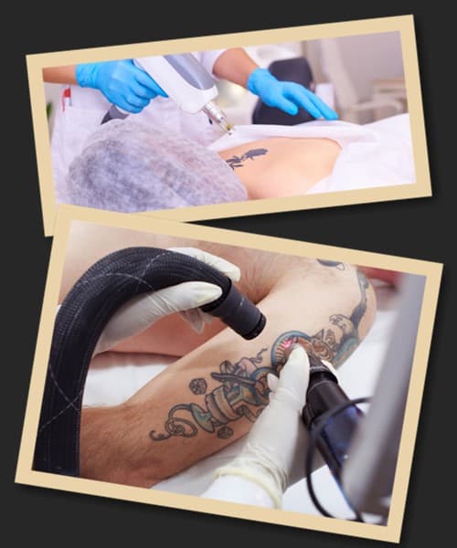 Лазер як найкращий спосіб видалення тату