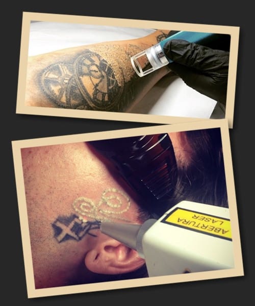 видалити тату лазером