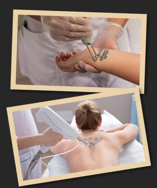 Фактори, що впливають на ефективність лазерного видалення татуювань