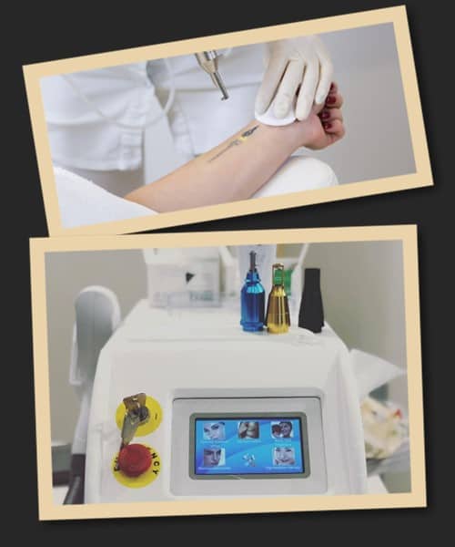 видалити тату лазером