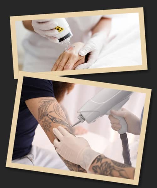 виведення татуювання