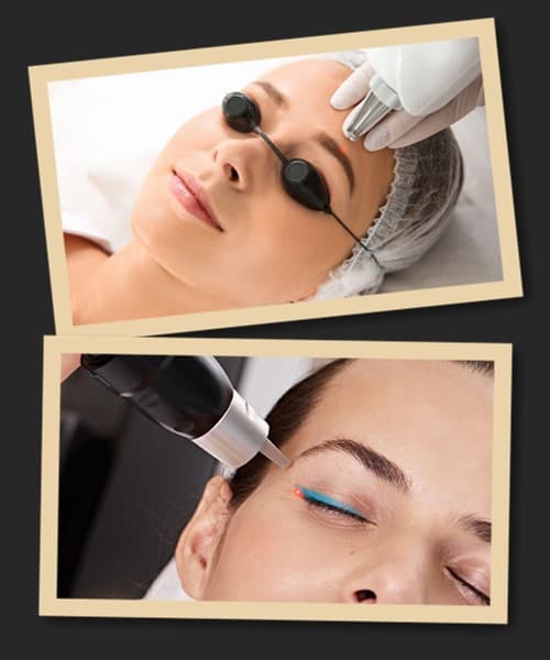 Як відбувається видалення татуажу лазером