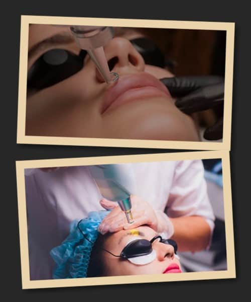 Методи зведення татуажу