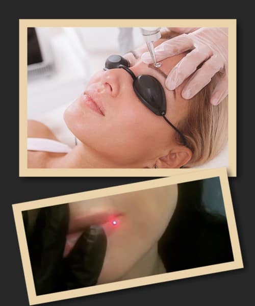 лазерна методика зведення татуажу