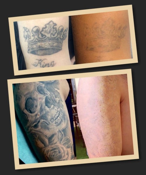 як зводять тату лазерним апаратом