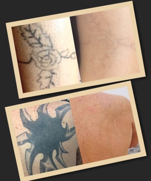 як зводять тату