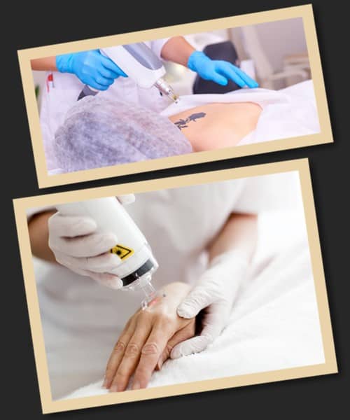 Зведення тату лазером