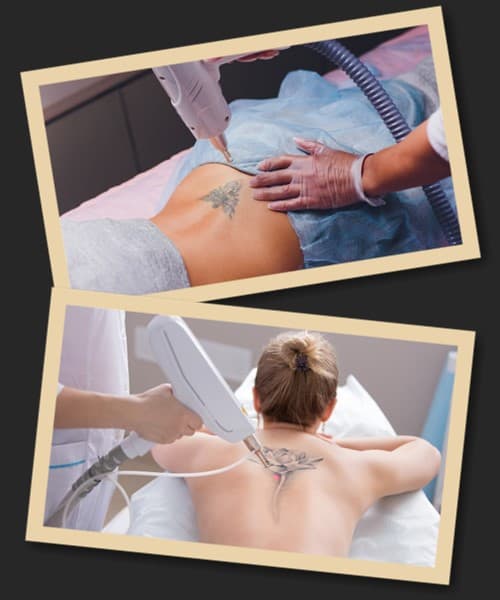 виводити татуювання лазером