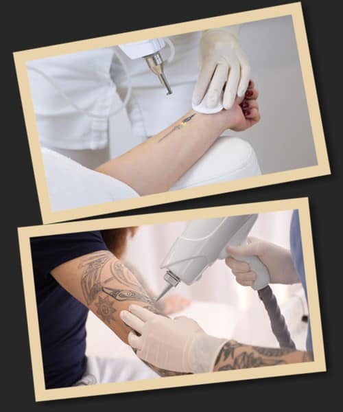 як прибрати татуювання