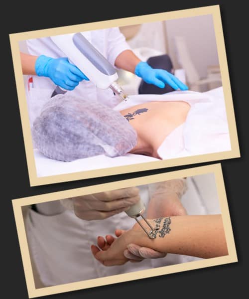 Лазерний метод виведення татуювань