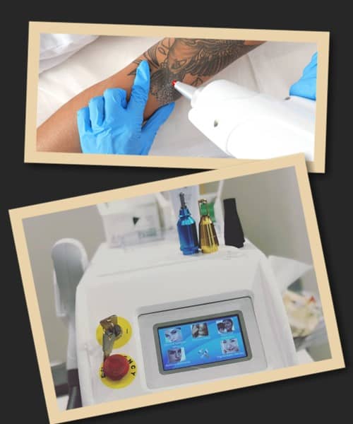 Лазерний метод видалення тату