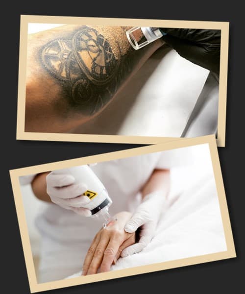 ефективність виведення татуювань лазером